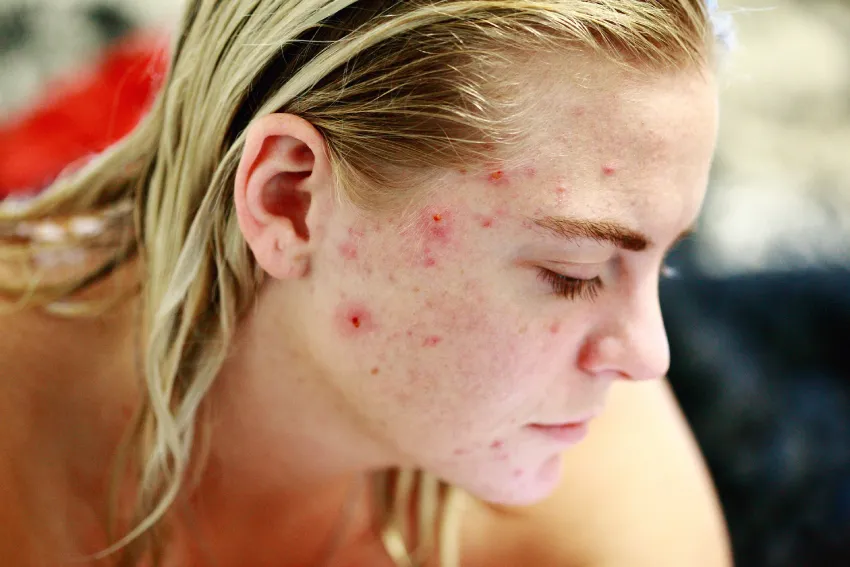A lady with acne on her facec