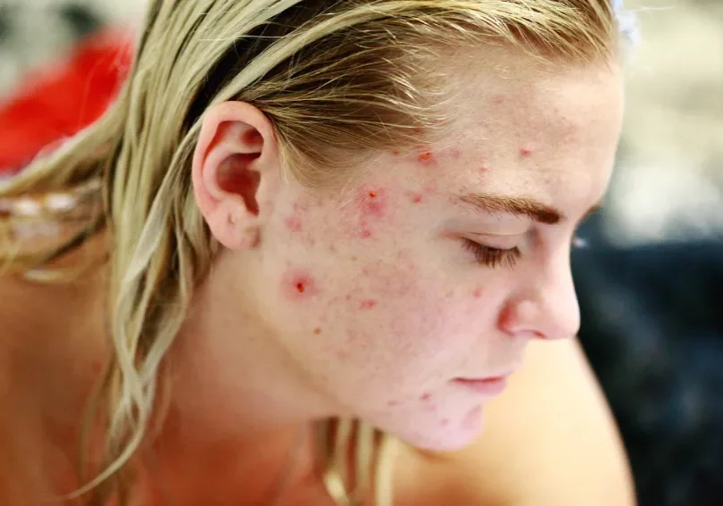 A lady with acne on her facec
